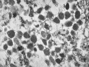 unclassified pancreatic tumor unclassified pancreatic tumor